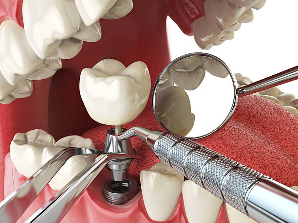 Best Emergency Root Canal Treatment in Wickerham Manor Fisher, PA
